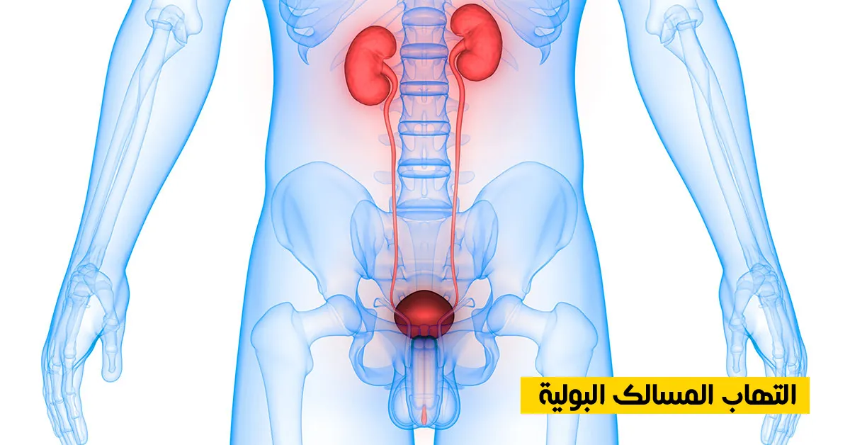 التهاب المسالك البولية